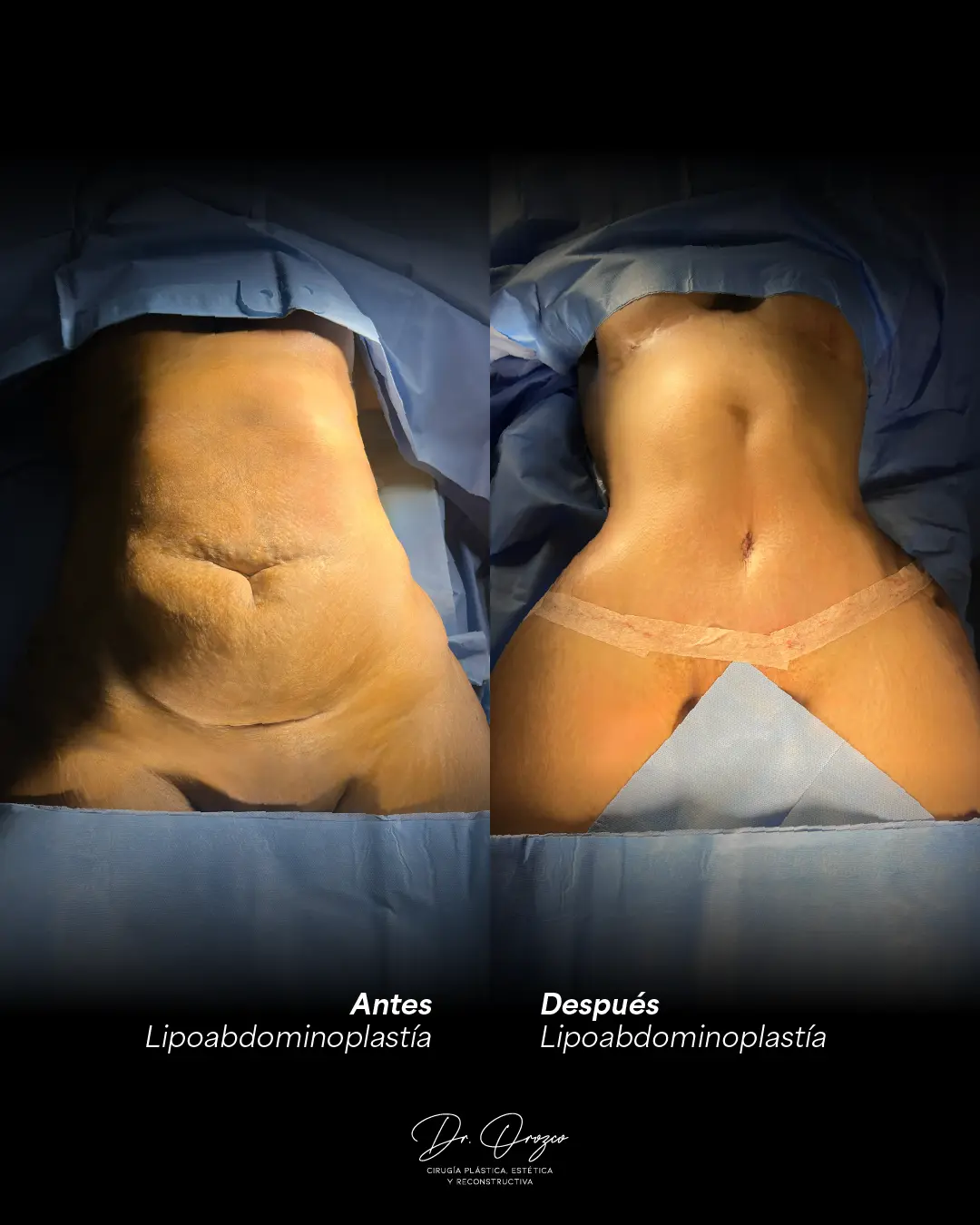 Abdomen antes y después de una lipoabdominoplastia