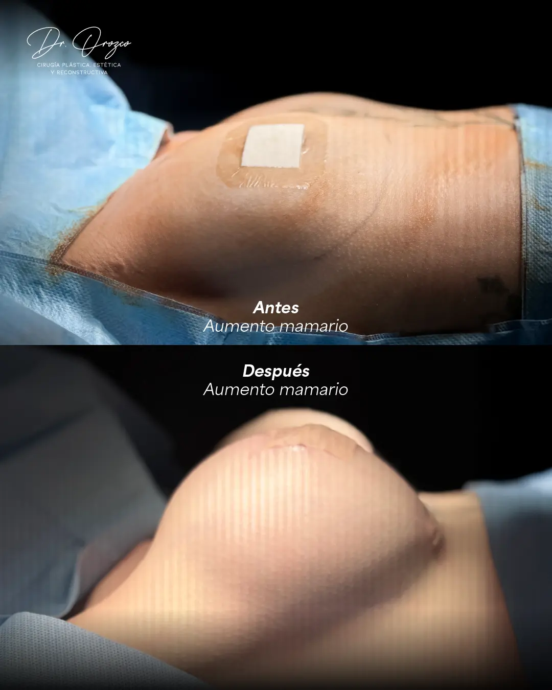 Mama antes y después de colocar el implante durante un aumento mamario