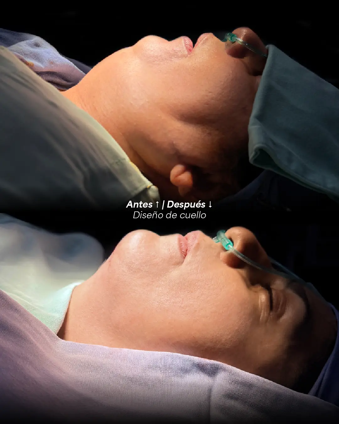 Ángulo del cuello y el mentón antes y después de un tratamiento de cuello