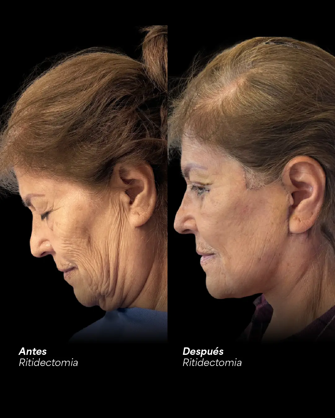 Rostro y cuello de perfil antes y después de un lifting facial