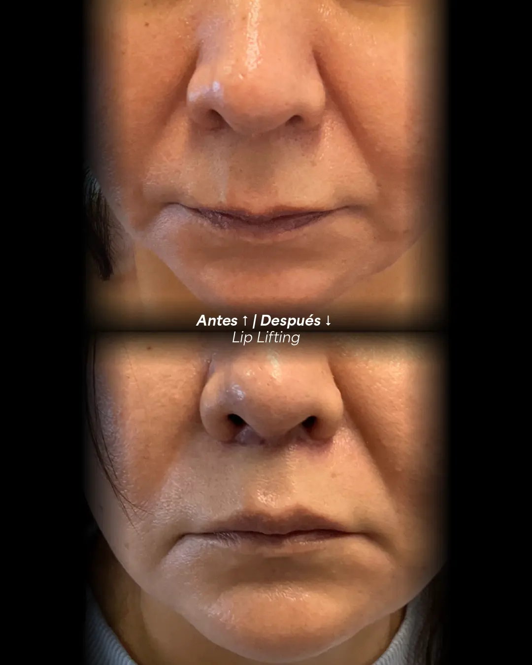Labio superior antes y después de un lip lifting