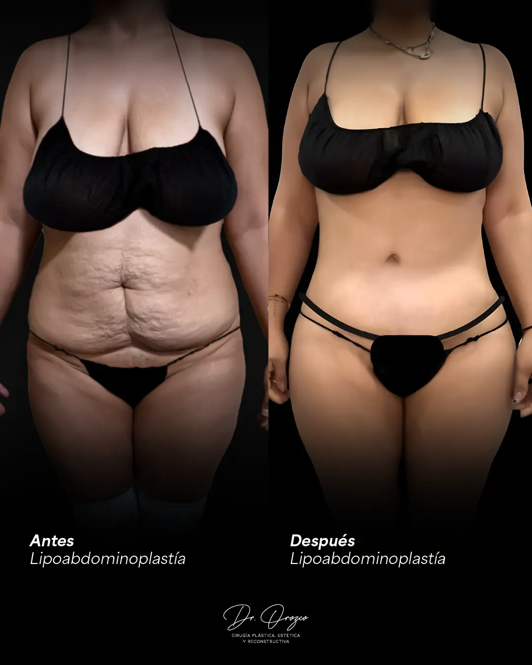Abdomen antes y seis meses después de una lipectomía abdominal con reparación muscular
