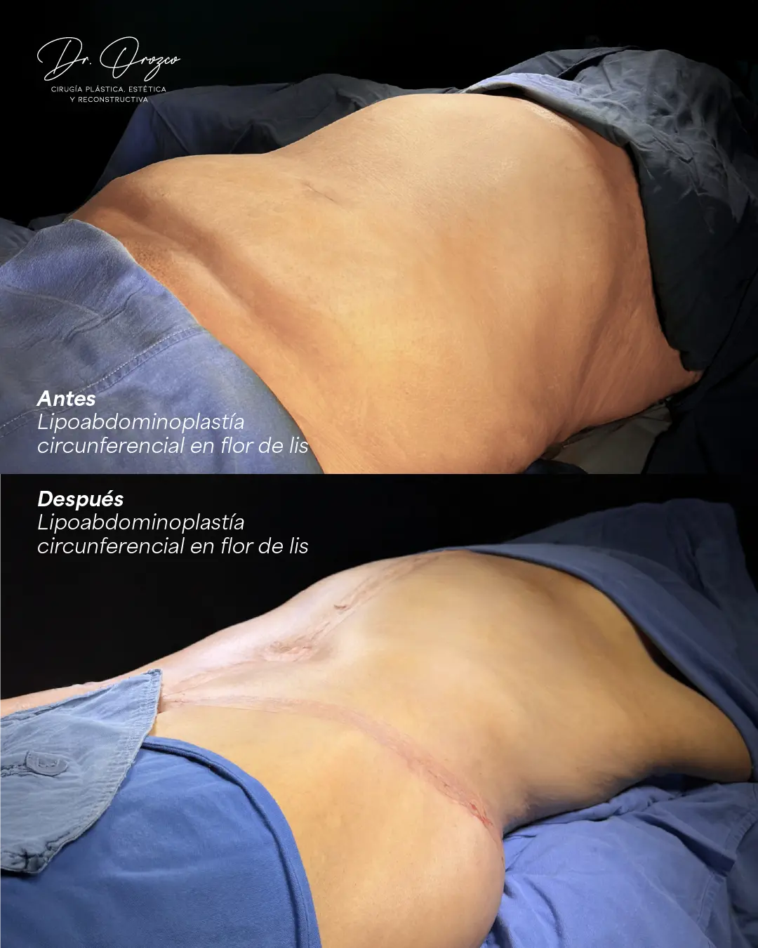 Perfil abdominal antes y después de una lipoabdominoplastia