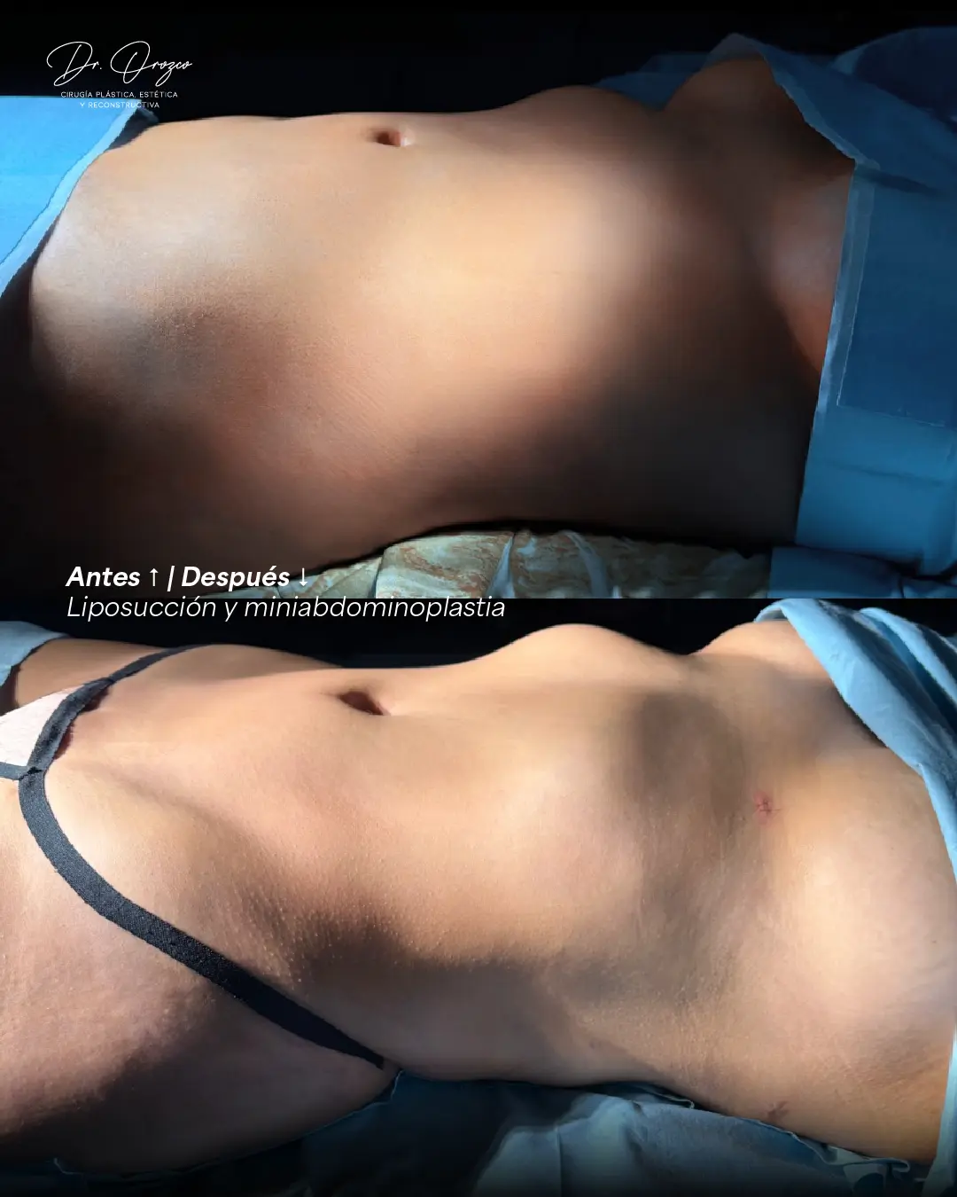 Abdomen y cintura antes y seis meses después de una liposucción 360° en Mérida