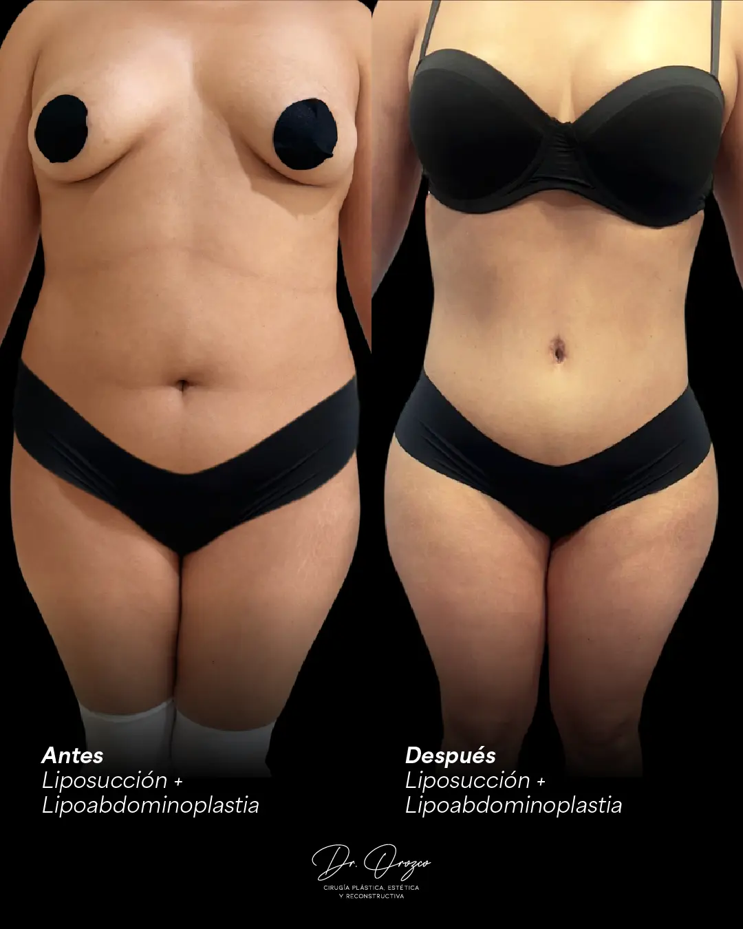 Abdomen y cintura antes y después de una liposucción con lipoabdominoplastia