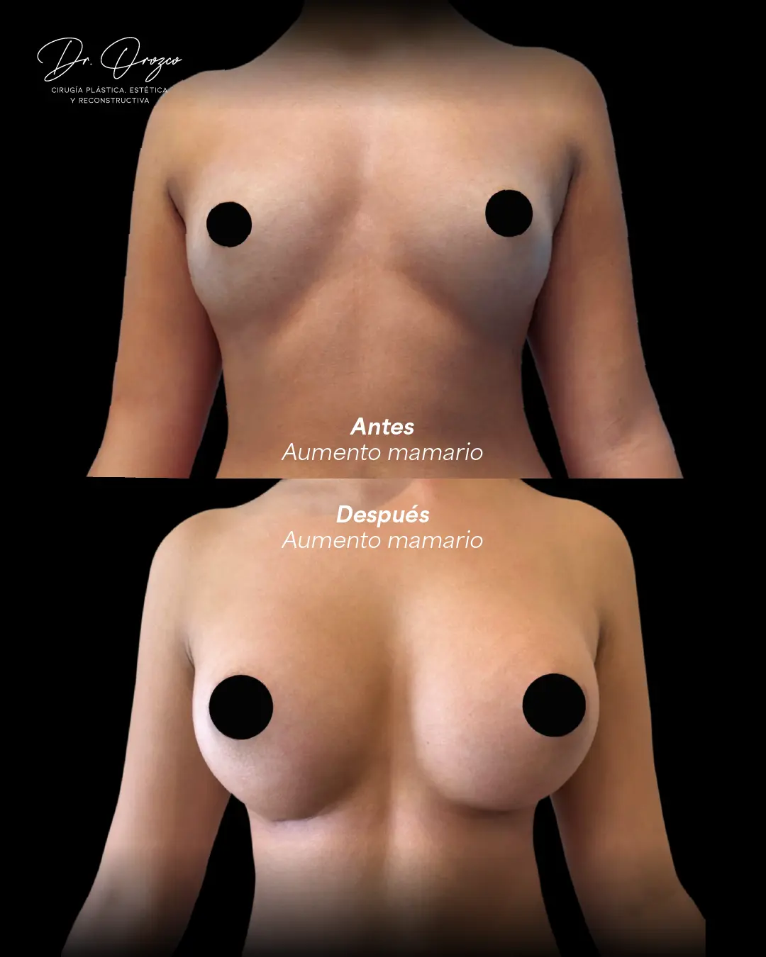 Resultado de una mamoplastia de aumento tres meses después de la cirugía