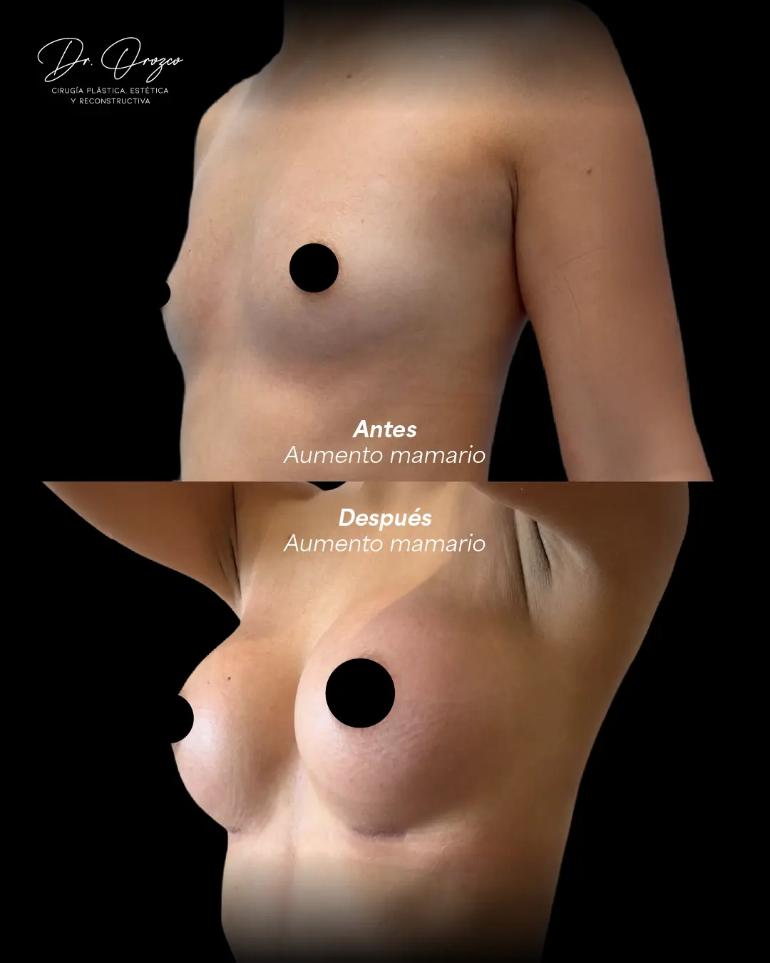 Perfil del busto antes y después de un aumento mamario con implante