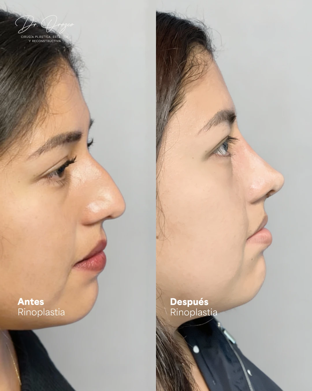 Perfil de la nariz antes y después de una rinoplastia