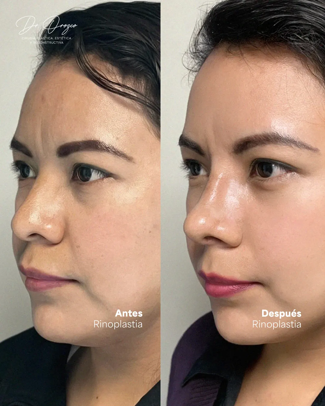 Nariz antes y después de una rinoplastia, vista de tres cuartos