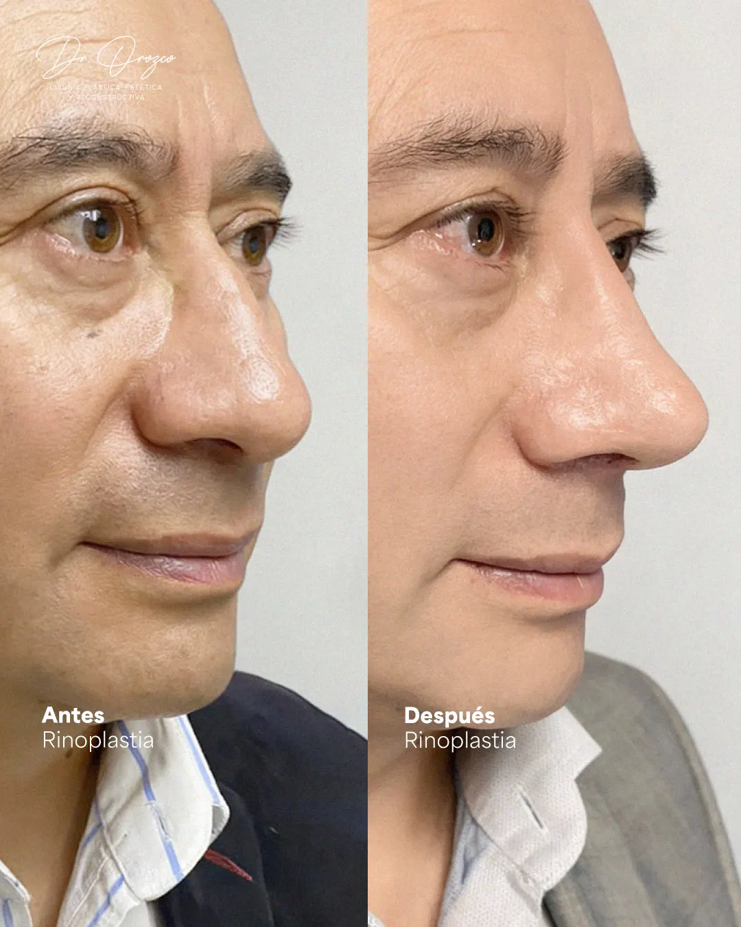 Dorso y punta nasal antes y después de una rinoplastia en un paciente varón