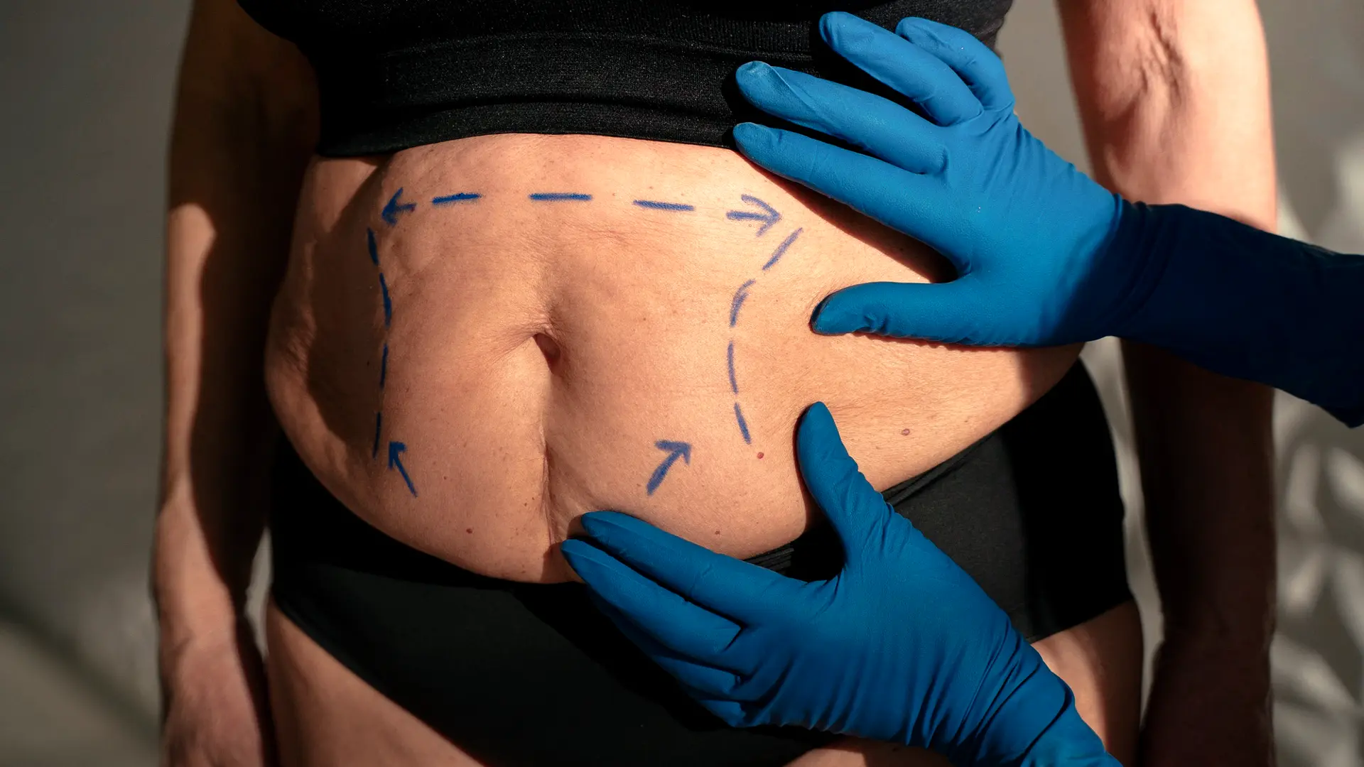Lipectomía abdominal con reparación muscular en Mérida